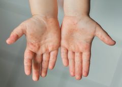 Kasus Campak di Sumut Tembus 362, Vaksinasi Dikebut untuk Tekan Wabah